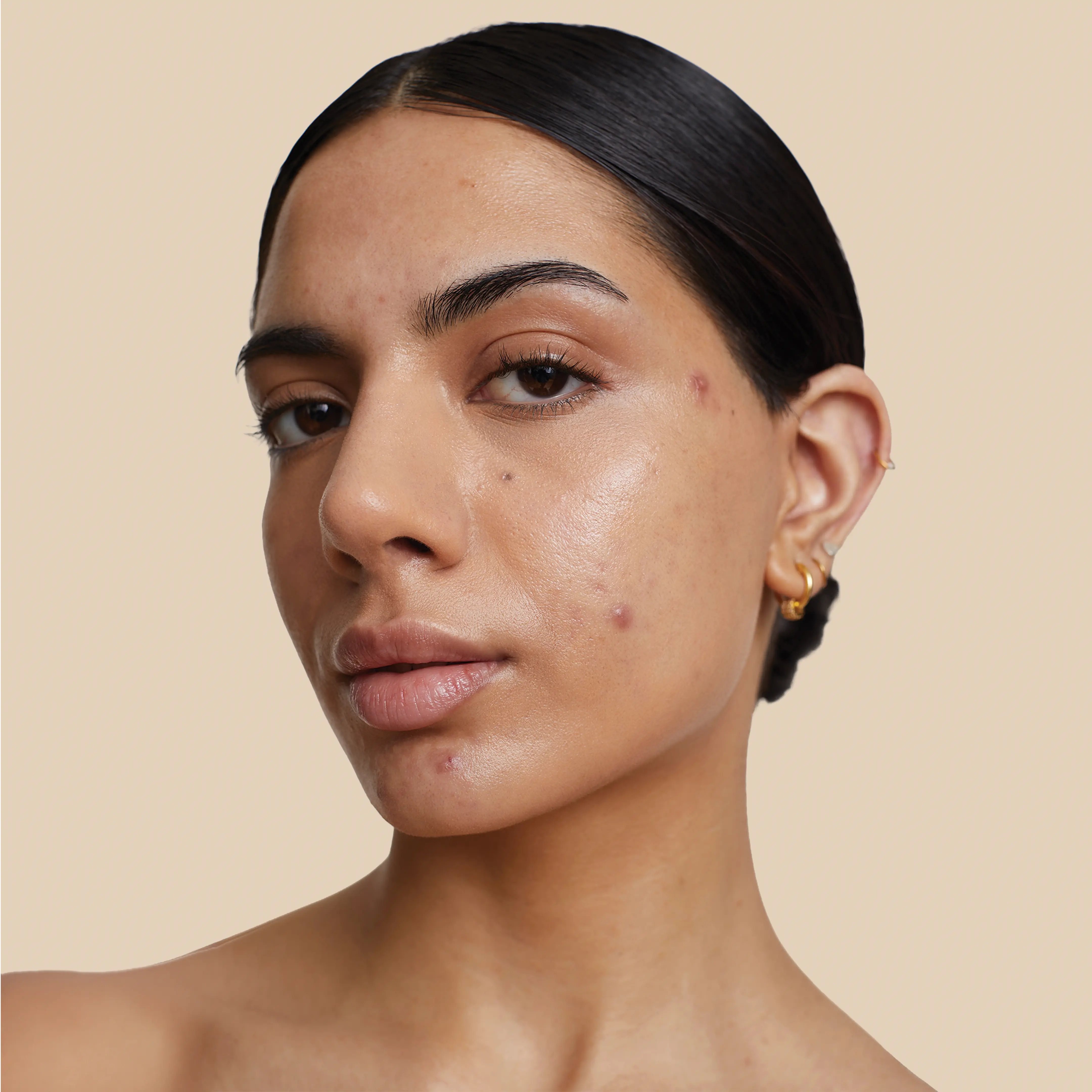 Before using Krti Herbals anti acne cream and rose water showing smooth, and bright skin