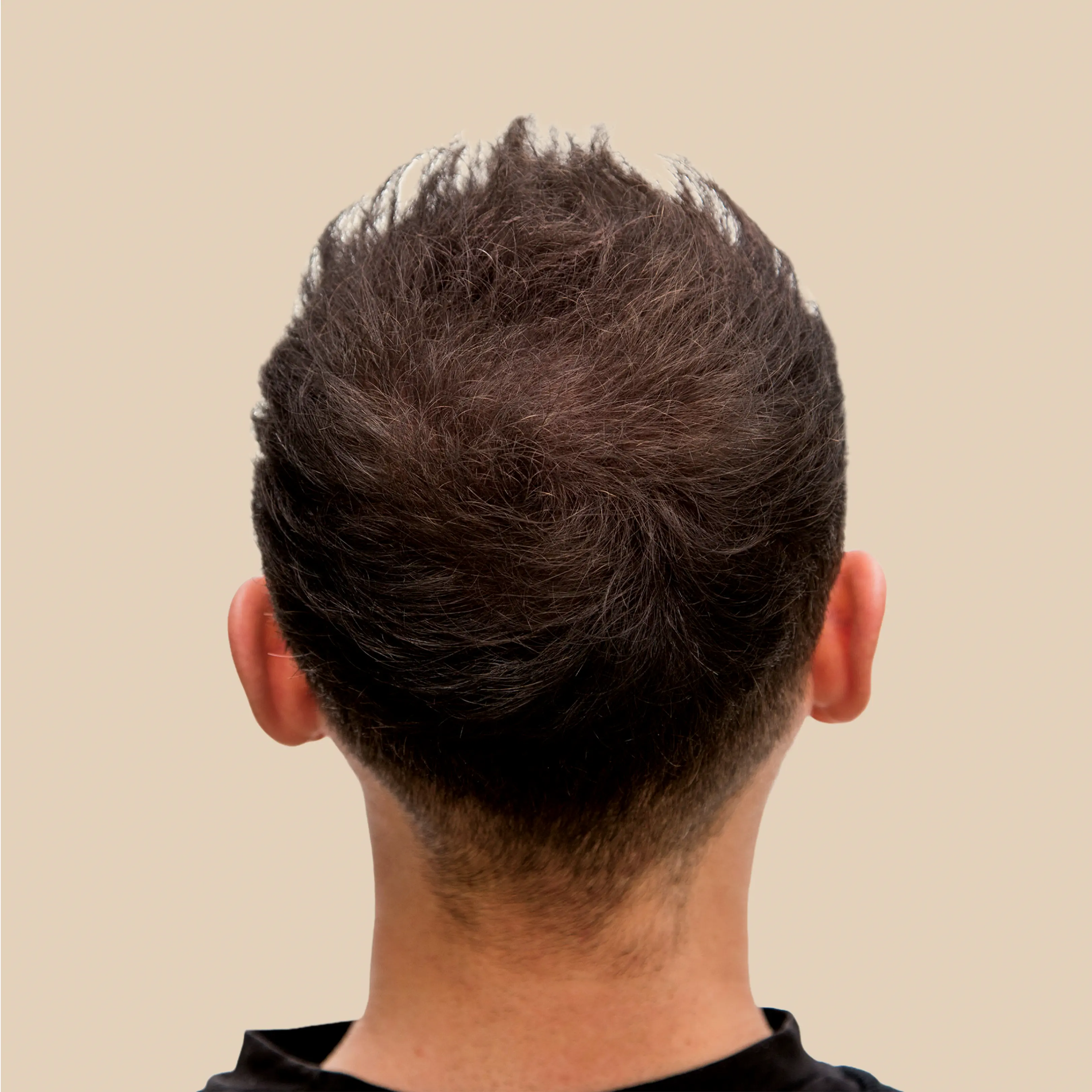  After results of using Krti Herbals Hair Growth Oil showing visible hair growth