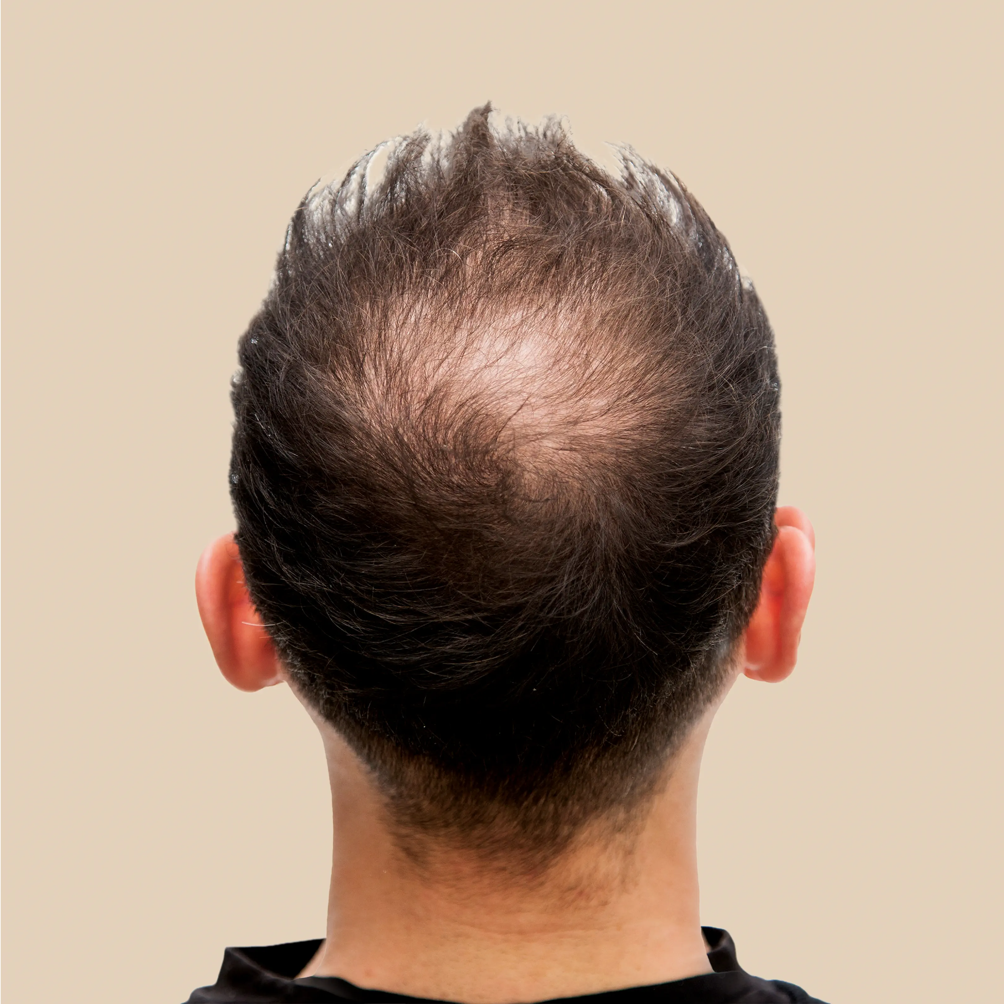 Before using Krti Herbals Hair Growth Oil showing hair with skin.