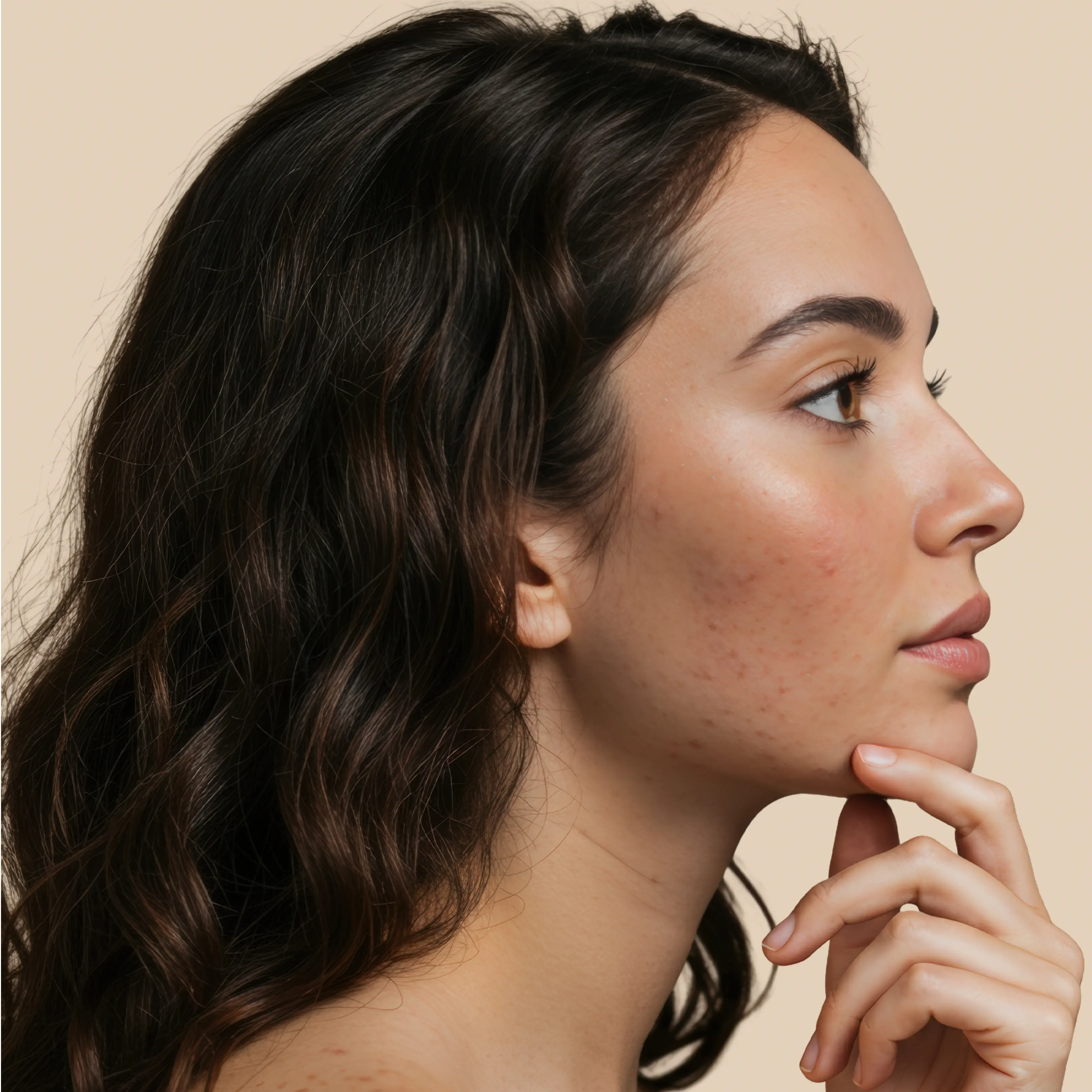 Before using Krti Herbals No Marks Cream showing uneven skin tone and dark spots